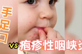 宝宝嘴上有小泡就是手足口？不一定，还有可能是这种病视频封面