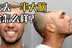 如果人类失去一半大脑，会发生什么？“无脑症”又是什么？视频封面