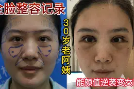 30岁老阿姨全脸整容记录，眼综合面部填充手术，30天后颜值逆袭视频封面