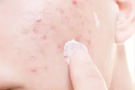 阿达帕林凝胶的用法是什么？治疗轻、中重三度痤疮，用法各有不同视频封面