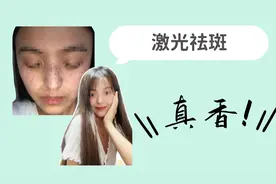 【Vlog 01】上海九院做激光祛斑，斑斑点点都不见，效果真不错！视频封面