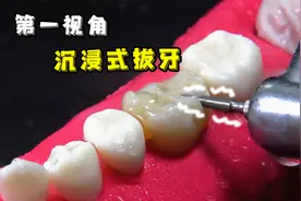 根管治疗蛀牙全过程，看着就觉得痛...大家一定要好好刷牙啊！视频封面