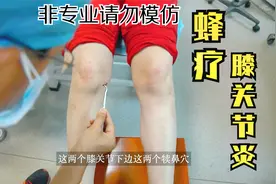 揭秘蜂疗现场，医生是如何用蜜蜂治疗膝关节炎的呢？视频封面