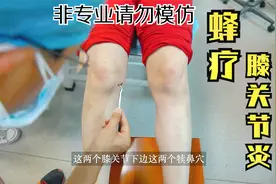 揭秘蜂疗现场，医生是如何用蜜蜂治疗膝关节炎的呢？视频封面