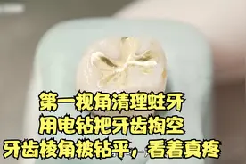 第一视角清理蛀牙，用电钻把牙齿掏空，牙齿棱角被钻平，看着真疼视频封面