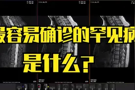 极罕见的病例，却又是最容易诊断的病例，它是什么呢？视频封面
