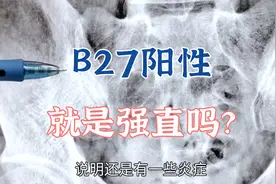B27阳性能说明什么？强直性脊柱炎是怎么诊断的？肖教授告诉你