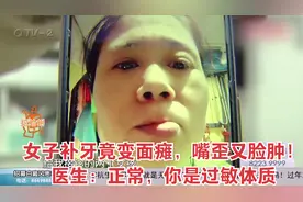 女子补牙竟变面瘫，嘴歪又脸肿！医生：正常，你是过敏体质