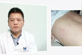 身上长出这种红疙瘩或是得了螨虫性皮炎 很多人以为是被蚊虫叮咬