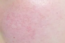 如何去除脸上的红血丝？教你一个简单的方法，这方法太棒了