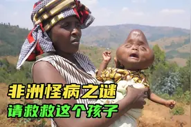 怪病之谜：刚出生的婴儿得怪病长相奇特像怪物视频封面