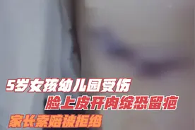 5岁女孩幼儿园受伤，脸上皮开肉绽恐留疤，家长索赔被拒绝视频封面