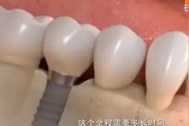 牙齿缺失一定要补牙！种植牙全过程大揭秘，缺牙的朋友了解一下视频封面
