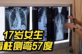 17岁女生脊柱侧弯57度，家长担心孩子过早手术影响身高视频封面