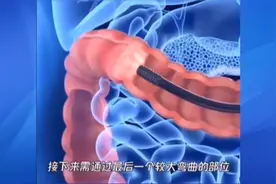 动画演示肠镜全过程~