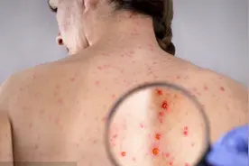 为什么宝宝会得婴儿湿疹？这3个原因要一一排除，家长们要谨记了