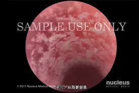 宫腔镜检查视频封面