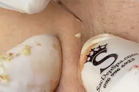 看看给7天没好好洗脸的小姐姐挤黑头吧视频封面