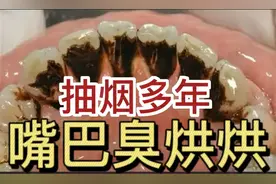 抽烟多年！如何拥有清新口气？口腔科专业人士都在用的方法赶紧学