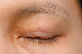 眼皮上长了脂肪组织“小肉粒”该如何解决？提醒：别再干傻事视频封面