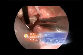 【星医生】等离子刀儿童扁桃体部分切除术。视频封面