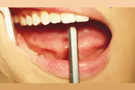 为什么有的人口腔内经常会溃疡，这到底是怎么回事呢？