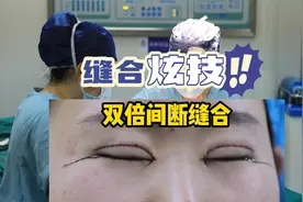 缝合炫技！双倍间断缝合法，术后恢复快、自然、痕迹浅视频封面