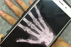 原来手机也有X光扫描功能，连手上的骨头都可以看到，非常清晰视频封面