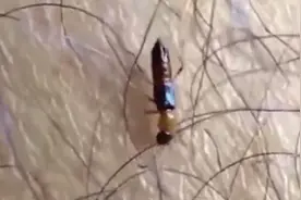 关灯玩手机遭遇隐翅虫，医生提醒：千万不要拍打！