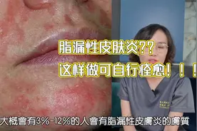有脂溢性皮肤炎？教你这样做可自行痊愈视频封面