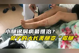 小腿银屑病最难治？女子腿上贴满“肉片”，老公看了吃不下饭视频封面