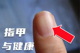 不同指甲，透漏出哪些身体健康信息？视频封面