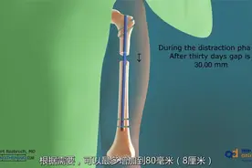 【3D演示】股骨截骨延长术视频封面