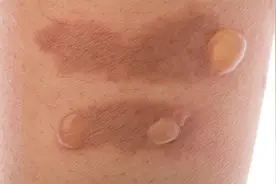烫伤后为什么会有水泡，怎么形成的？水泡怎么处理才不会留疤视频封面