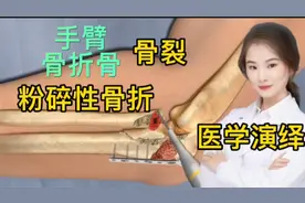医学演绎 人体手臂骨骨骼骨折粉碎性骨裂 医生是如何进行修复的视频封面