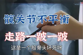 双侧髋关节不平衡，走路一跛一跛是怎么回事？肖教授讲解其中原因视频封面