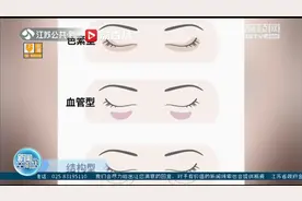 南京一医院开设“黑眼圈”门诊 专家支招各类黑眼圈治疗视频封面