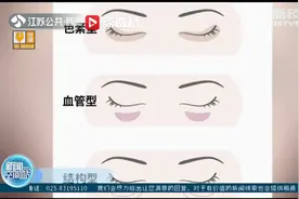 南京一医院开设“黑眼圈”门诊 专家支招各类黑眼圈治疗视频封面
