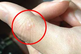 手上起小水泡瘙痒难耐，夏季反复发作，小伙用6块钱药膏治好了视频封面