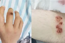 男子不慎遭万伏电压击中大难不死 医生：电流从右手流入右腿流出视频封面