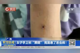 太吓人了！广西一女子手臂上长“黑痣”，竟是患了恙虫病？视频封面