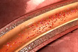 腿是血栓“报警器”？提醒：若有这4个症状，要当心血栓或已到来视频封面