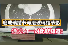 肺磨玻璃结节与磨玻璃结节影，是一样的吗？医生通过CT帮您区分
