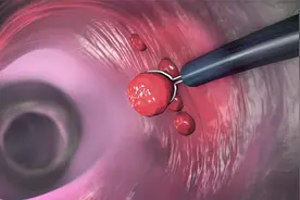 切除结肠息肉后，饮食牢记2吃1不吃，伤口好得快，降低复发率