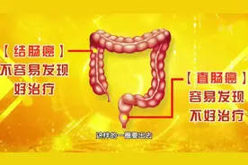 “15厘米的隐患”！一半肠癌发生在这个位置，好发现但不容易治疗视频封面
