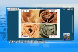 得风湿能引发心脏病?专家:年轻时不注意,小心心脏瓣膜疾病找上门