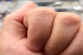 手上脚上长小泡，越抓越痒？教你简单方法，不花一分钱轻松消除视频封面