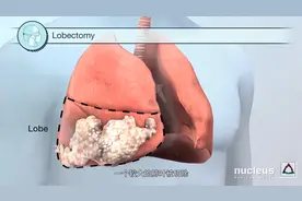 一个视频让您看懂肺部手术具体是怎么做的？