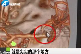 河南郑州：男子上厕所太用力导致脑内出血，医生给出这些建议视频封面