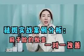 祛斑实战案例分享：麻子脸的蜕变，自信的女人最美丽！